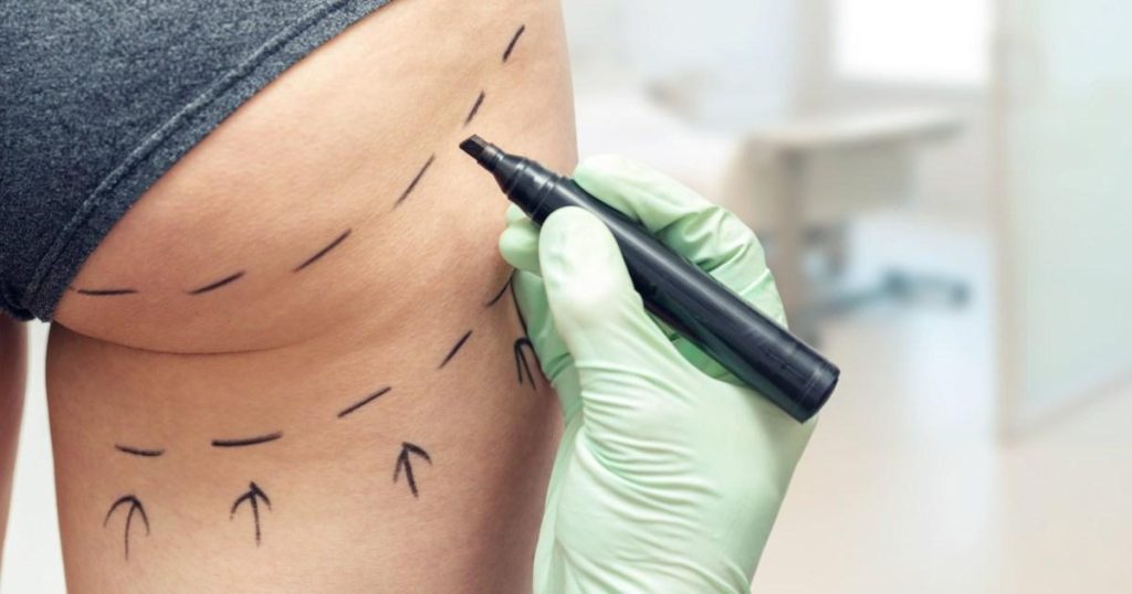 Caution Urged Against Discounted Buttock Augmentation Procedures During the Holiday Season