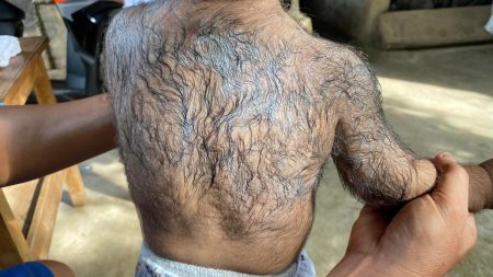 Concerns raised as babies display alarming symptoms of ‘werewolf syndrome’ after exposure to popular hair loss treatment minoxidil