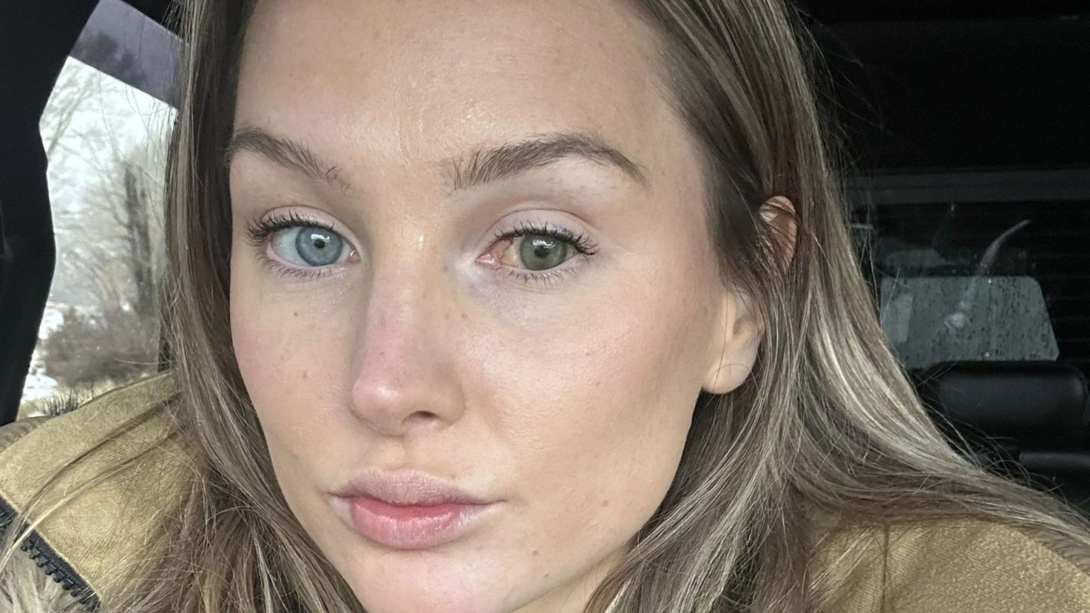 Vogue Model Suffers Permanent Vision Loss After Alleged Assault