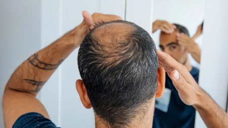 Finger Length Correlated with Increased Risk of Baldness, Doctor Claims