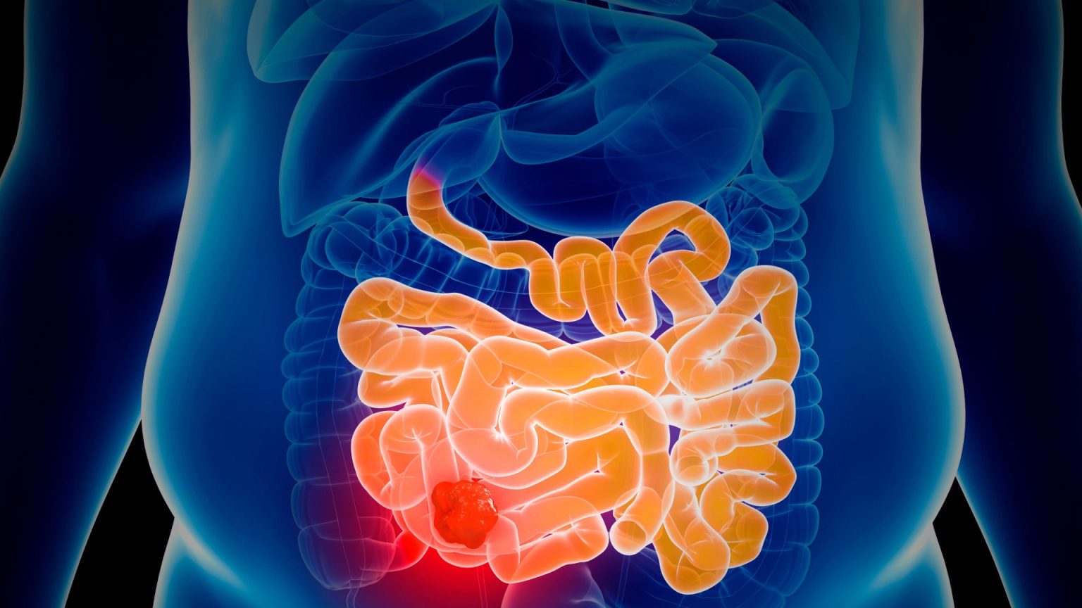 Rising Incidence of Bowel Cancer in Individuals Under 50: An Assessment of Risk, with Emphasis on England’s High Rates