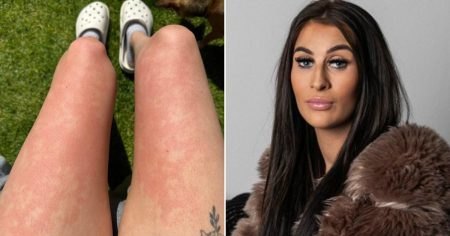 Woman has ‘excruciatingly painful’ one in 230,000,000 allergy