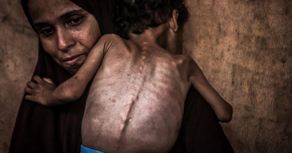 What happens to the body when it’s dying of starvation amid Gaza hunger crisis