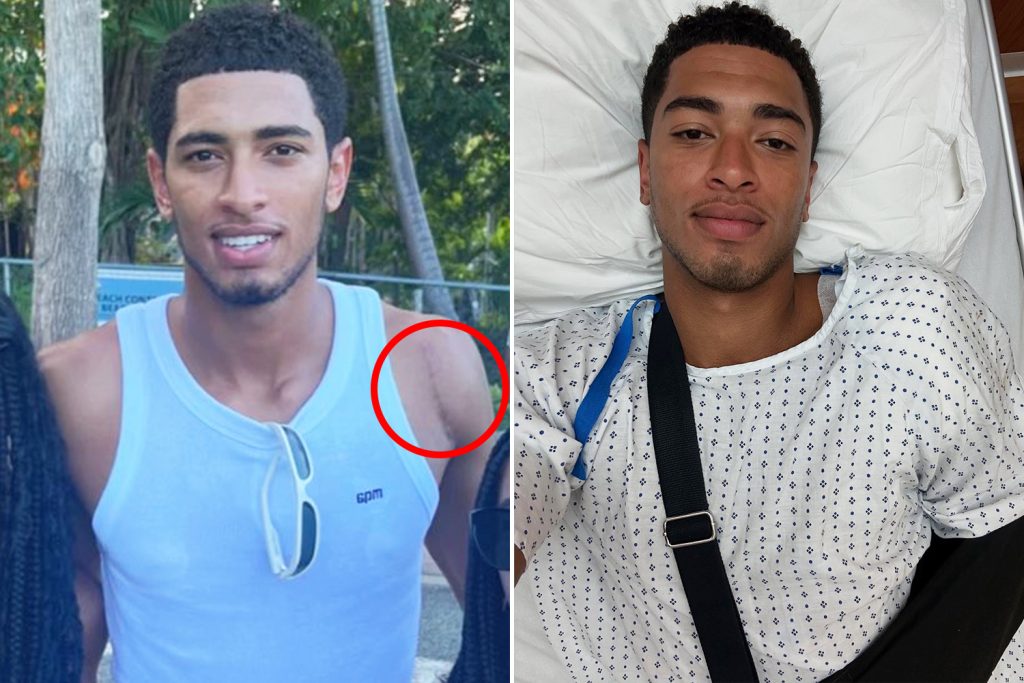 Jude Bellingham shows off huge scar after shoulder surgery as Real Madrid star recovers ahead of new season