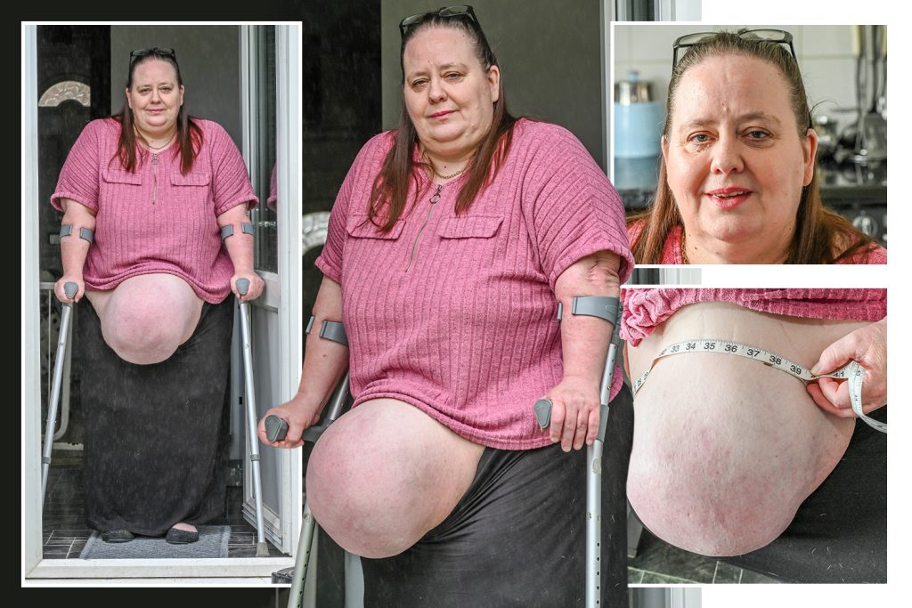 I have the biggest hernia doctors have ever seen – but they say surgery to remove it will kill me