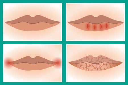 What your lips can reveal about your health – from deficiencies to nasty viruses and even cancer