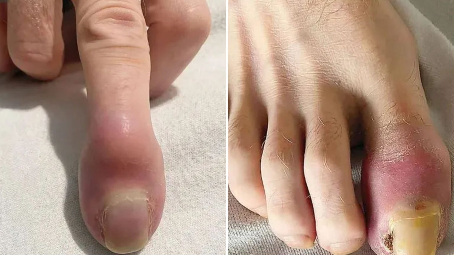 Weird swelling revealed first sign man’s fingers and toes were ‘completely replaced’ by cancer