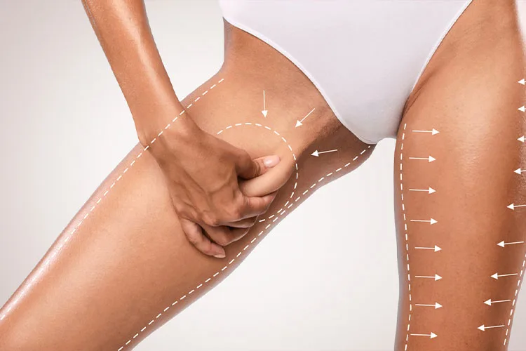 The Friction Point: Why Thigh Surgery Is About Comfort, Not Just Curves