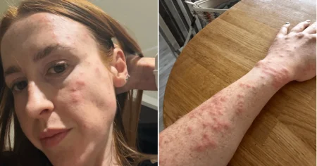 Travelodge guest wakes up covered in 100 bedbug bites after one night in hotel