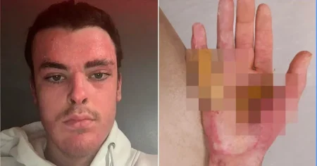 Apprentice welder wins six-figure payout after ‘human fireball’ work accident