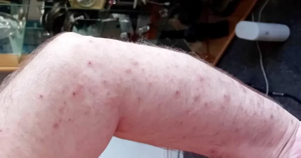 Man left with 1,000 bedbug bites following repeated infestations