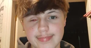 Teenager, 17, lost eye after ‘dud’ firework exploded in his face on Bonfire Night
